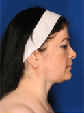 Patient # 66616 Before Photo # 1